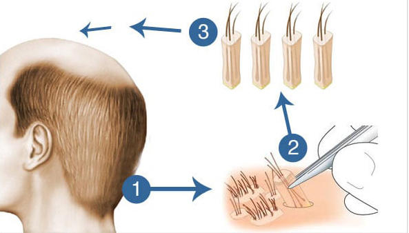 Hair Transplant Process